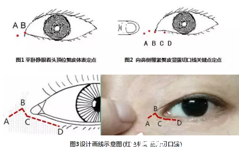 改良横一字法内眦赘皮矫正术