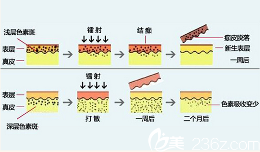 内蒙古永泰医院李旭光讲解祛斑的过程2