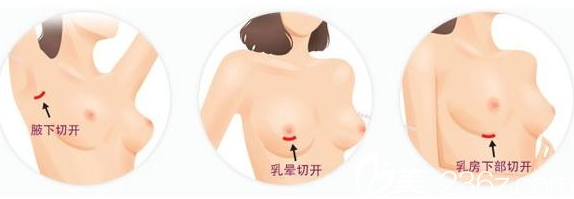 假体隆胸手术的切口有三种