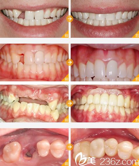宁波牙博士王道军种植牙案例