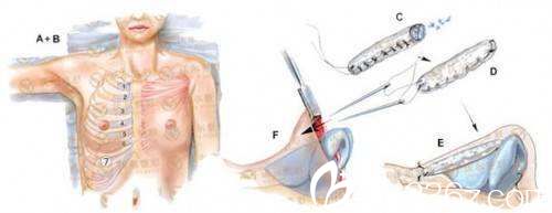 肋软骨隆鼻流程