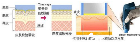 激光除皱过程