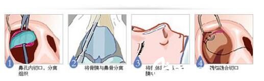 假体隆鼻的手术方法