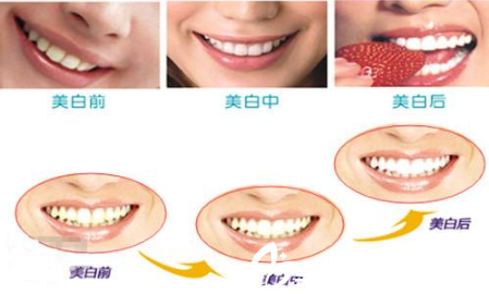 牙齿美白的几种方法