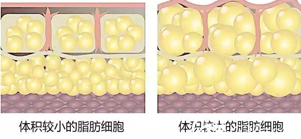 长春吴学军整形医院吸脂手术