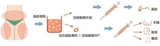 长春海峡整形医院医生讲解自体脂肪移植