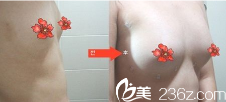 阜阳市人民医院整形美容外科隆胸案例