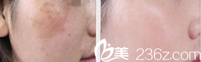北京中关村医院皮肤美容科案例
