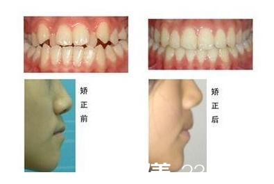 孟建牙齿畸形矫正案例